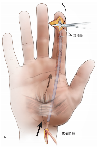 手指内部肌腱