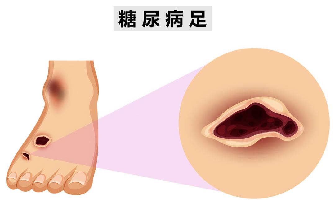 女性糖尿病的早期症状有哪些?