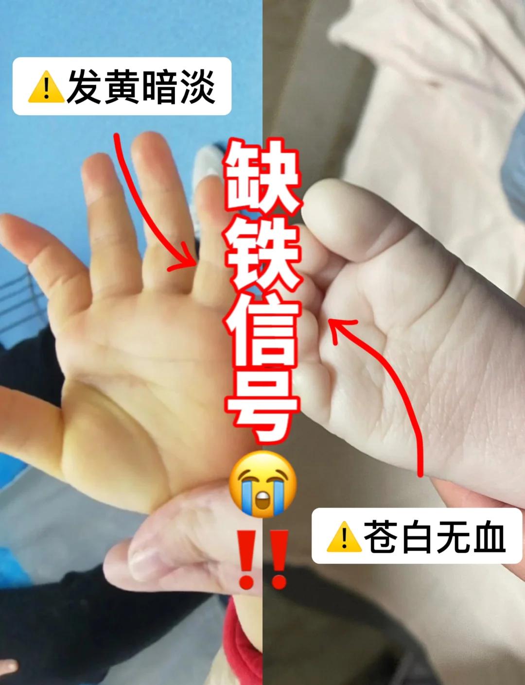 缺铁性贫血的危害