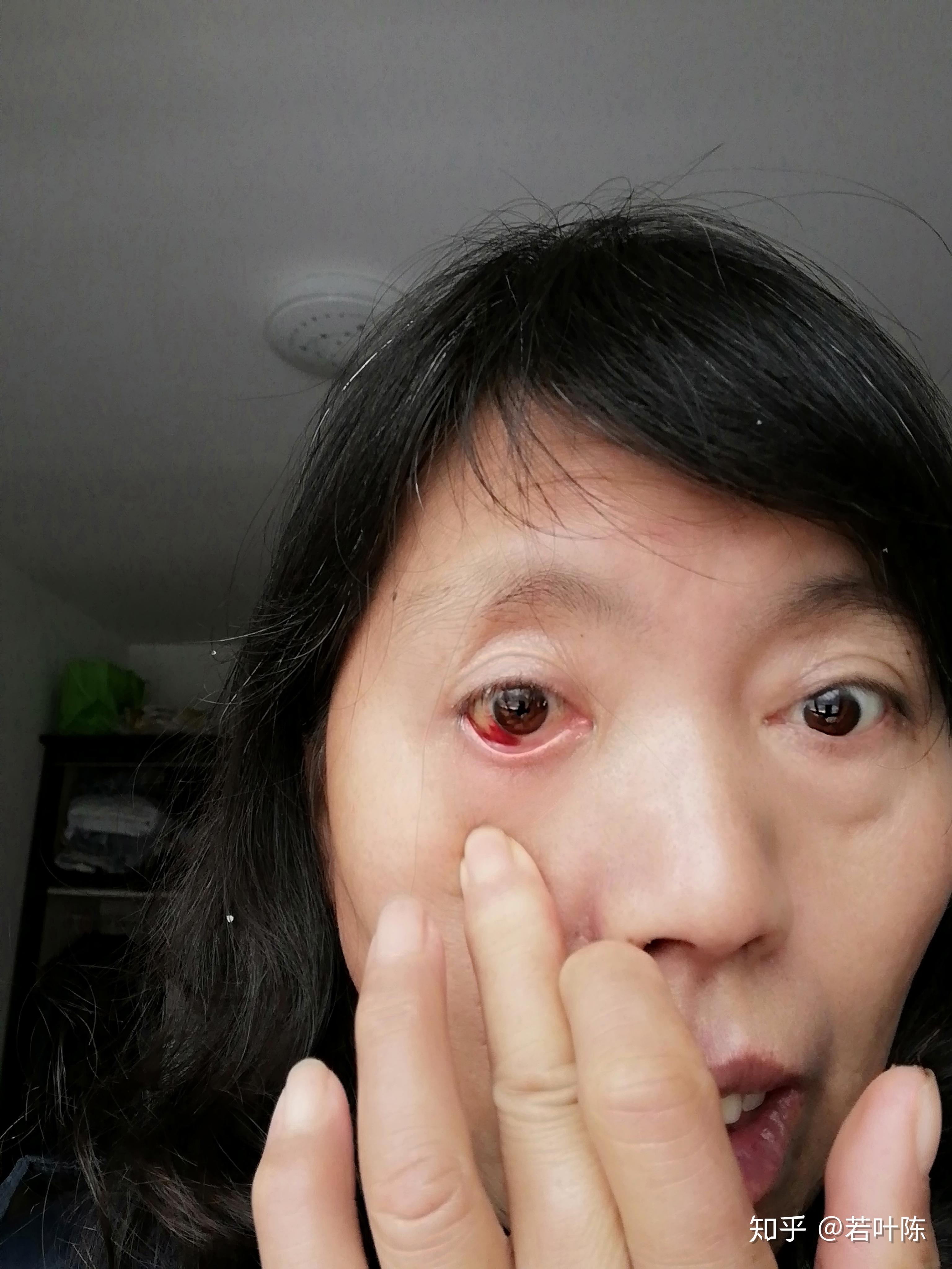 眼底出血吃什么药?