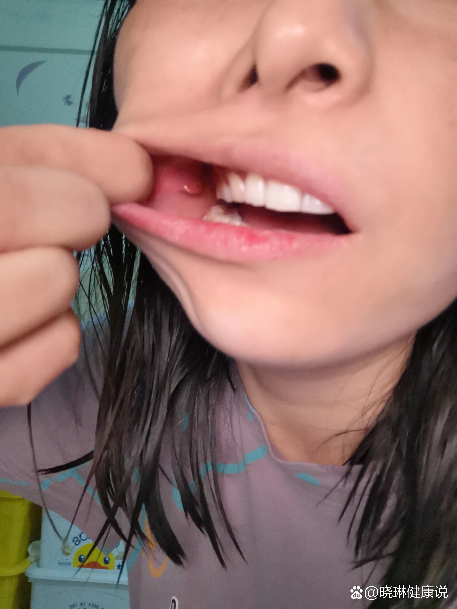 口腔内下颚长个硬疙瘩