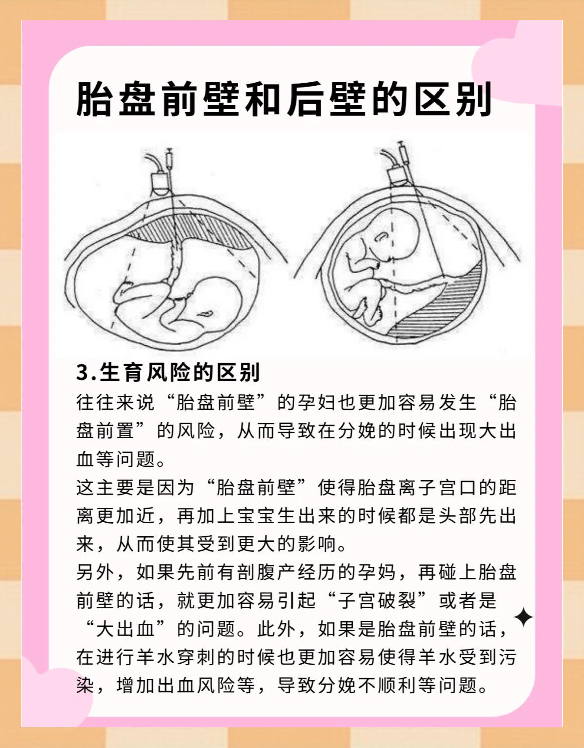 前置胎盘的病因有哪些
