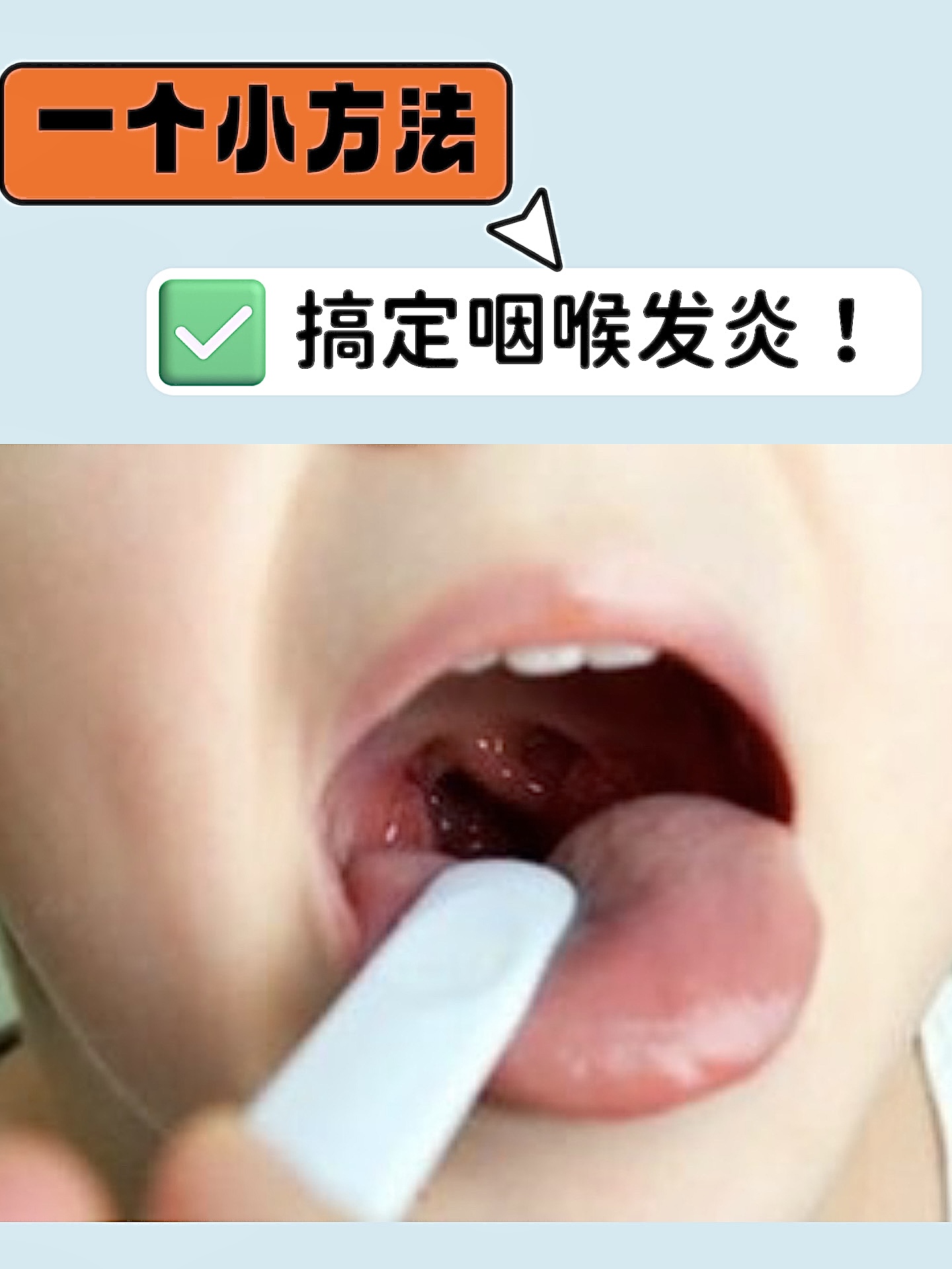 宝宝喉咙发炎如何治疗