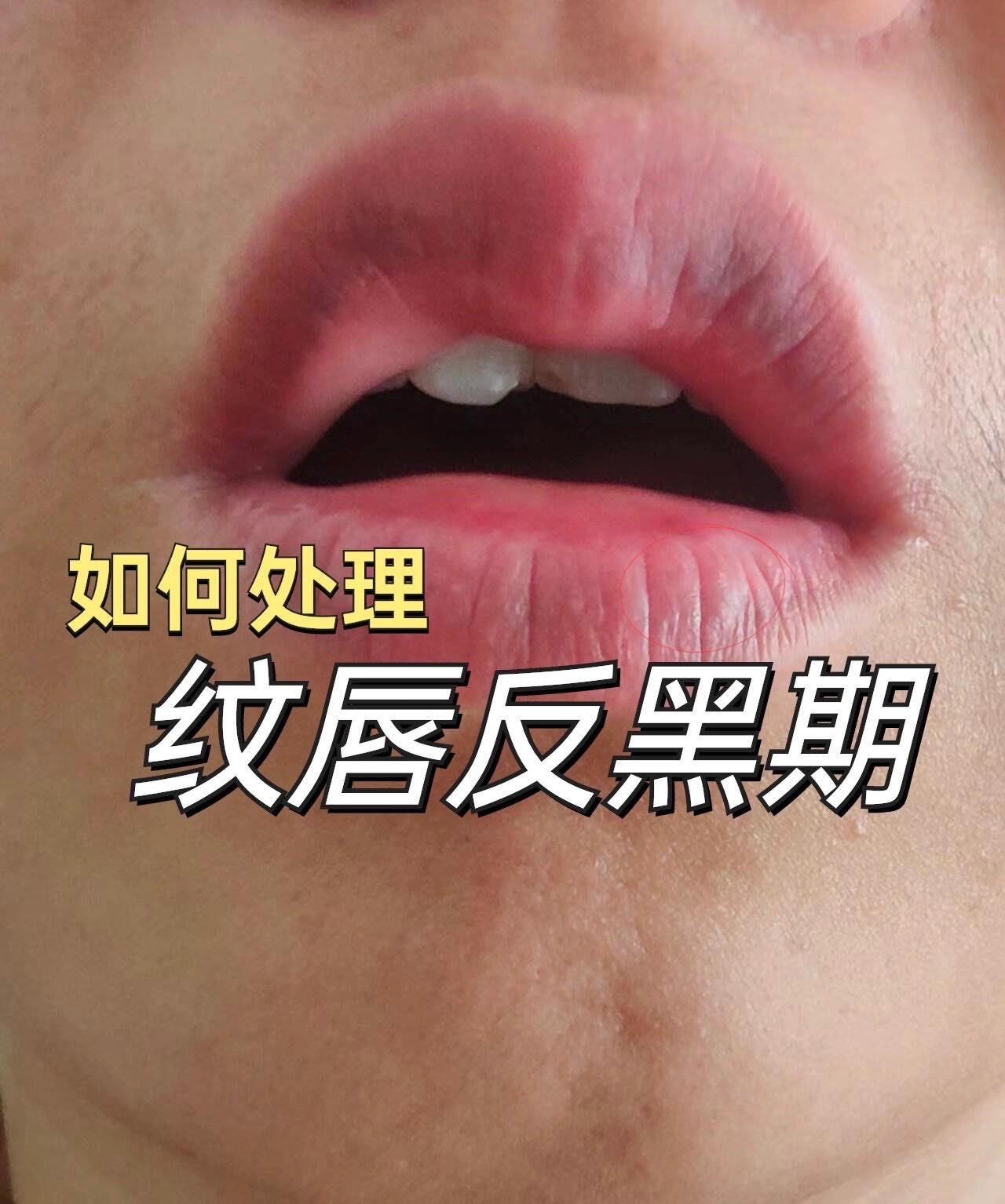 嘴唇边缘发黑怎么办