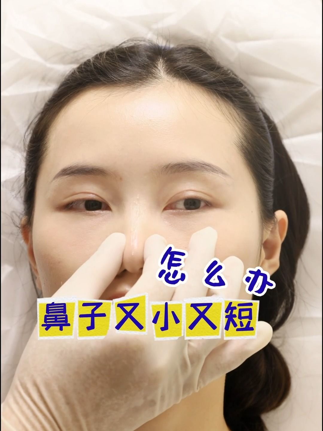 鼻子塌了怎么办