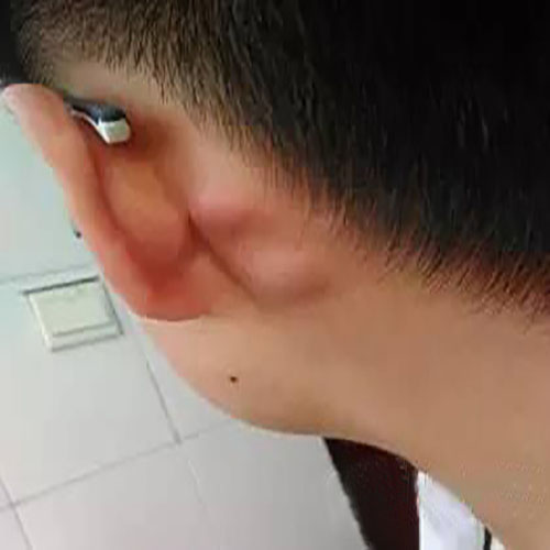 艾滋病淋巴结肿大