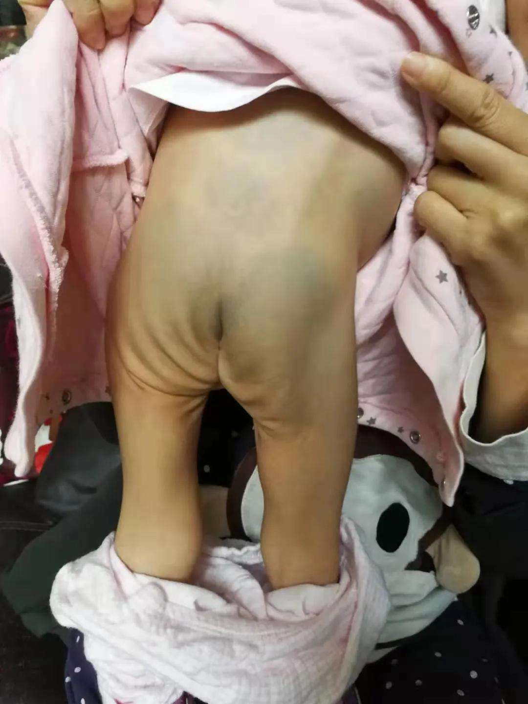 疳积怎么治
