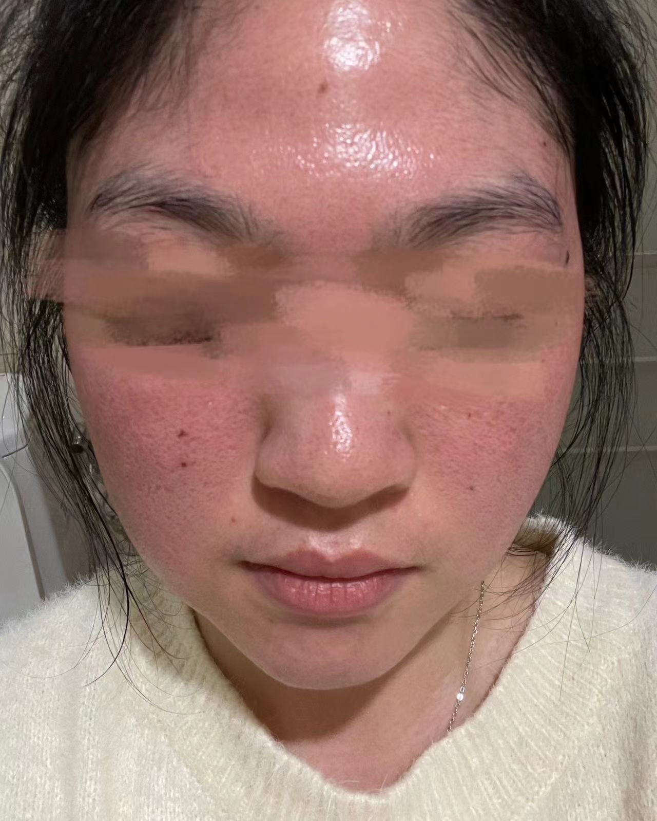 激素性皮炎能自愈吗