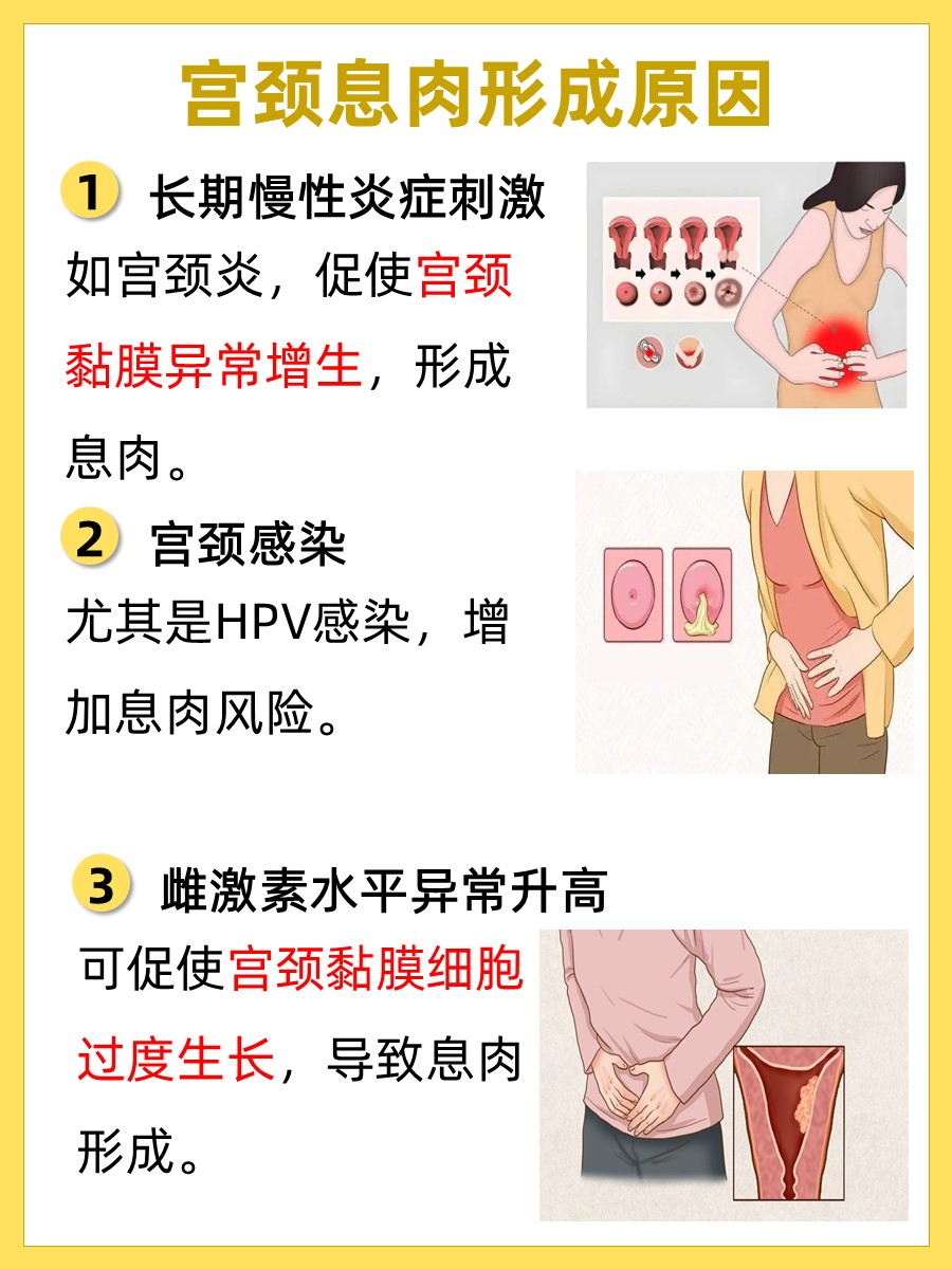 宫颈息肉不治疗要紧吗