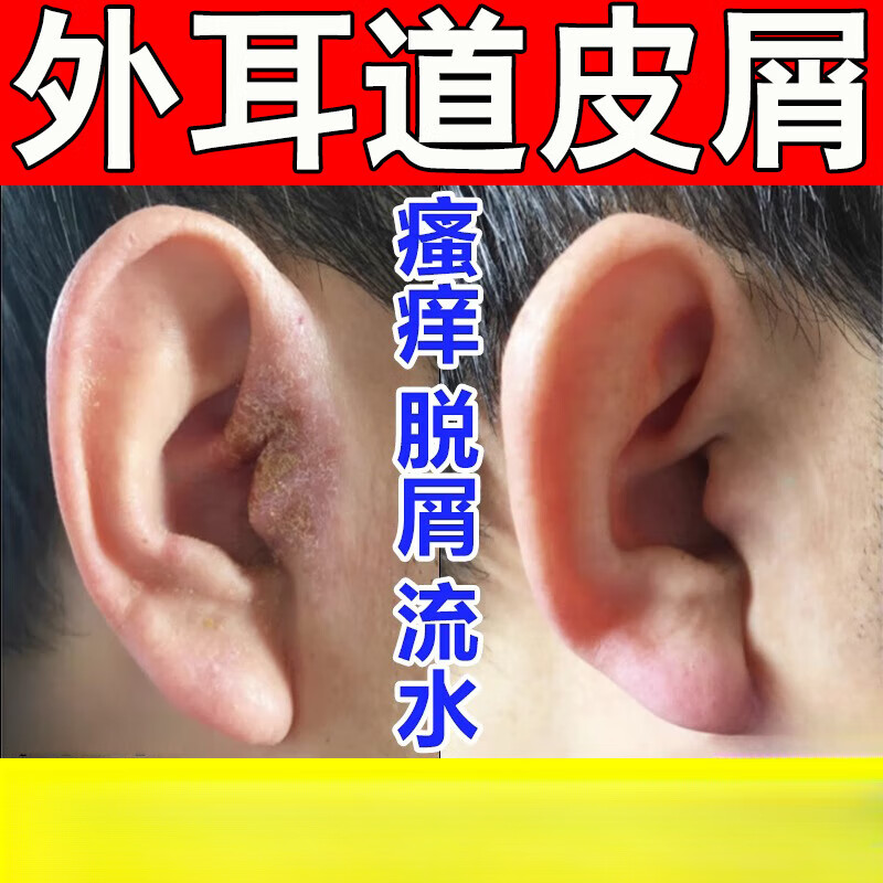真菌性外耳道炎怎么治疗