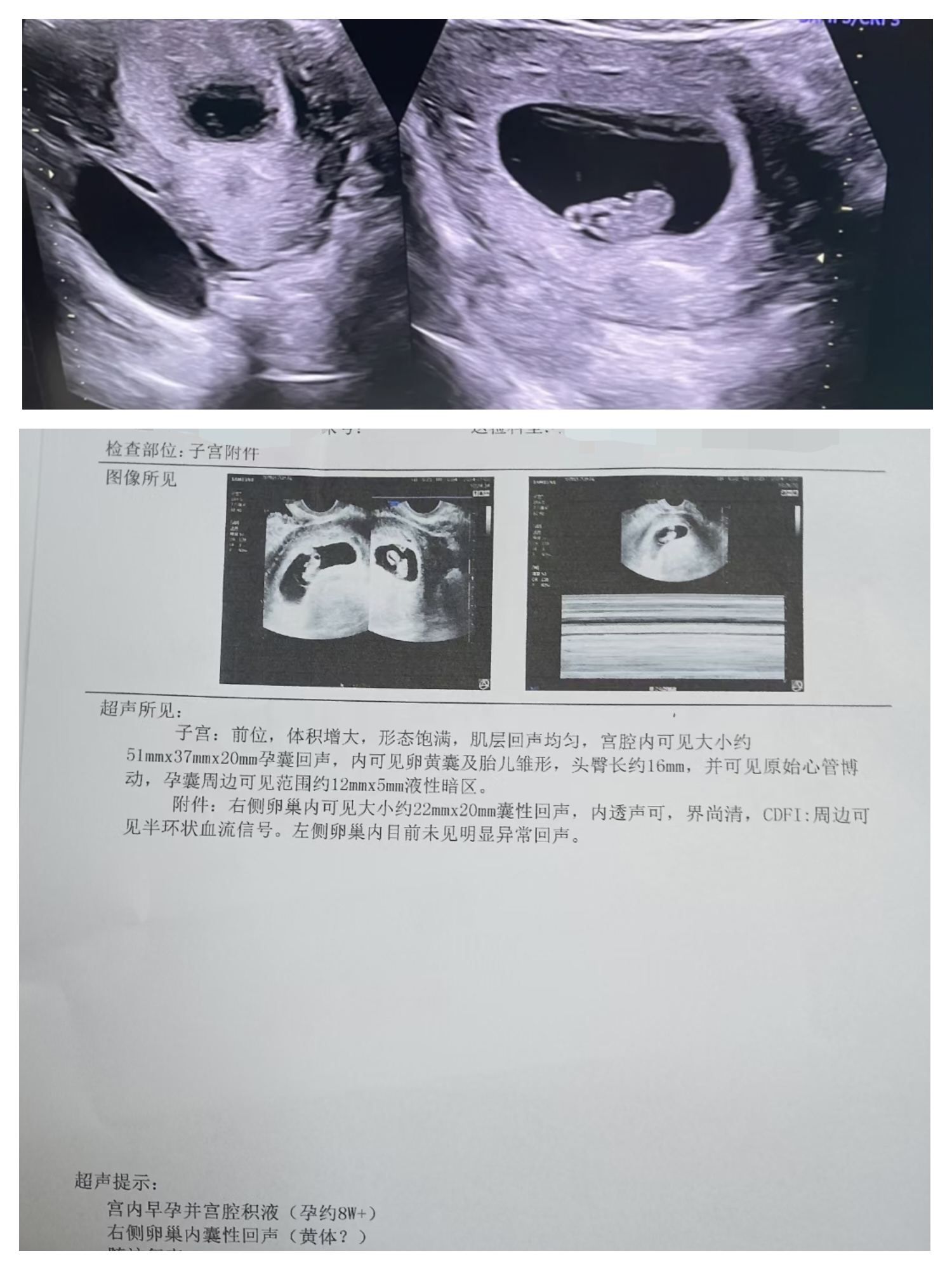宫外孕的几率大吗?