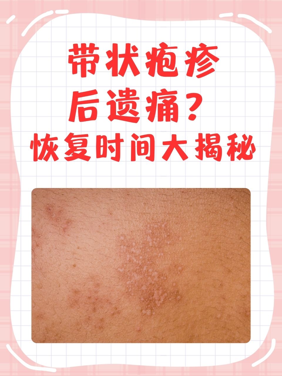 什么是带状疱疹?
