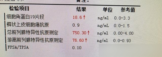 前列腺特异性抗原偏高,是癌吗