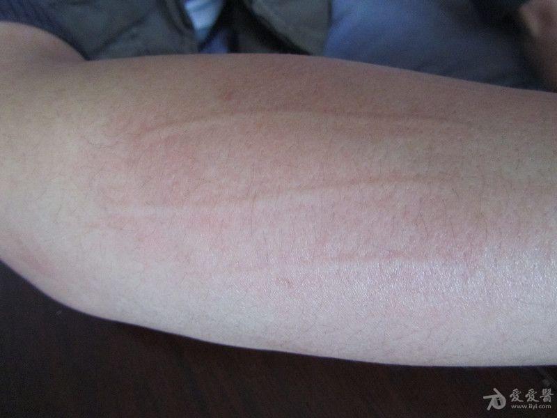 划痕性荨麻疹怎样治愈?