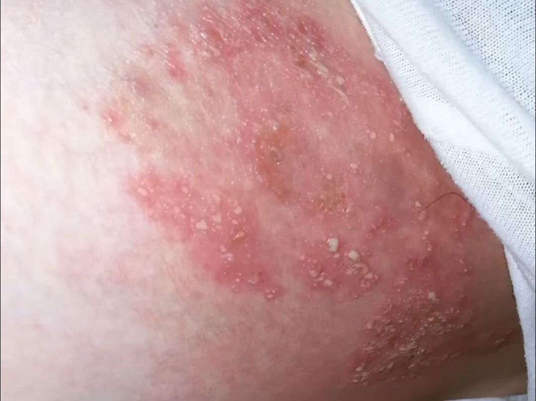 大腿内侧瘙痒什么原因