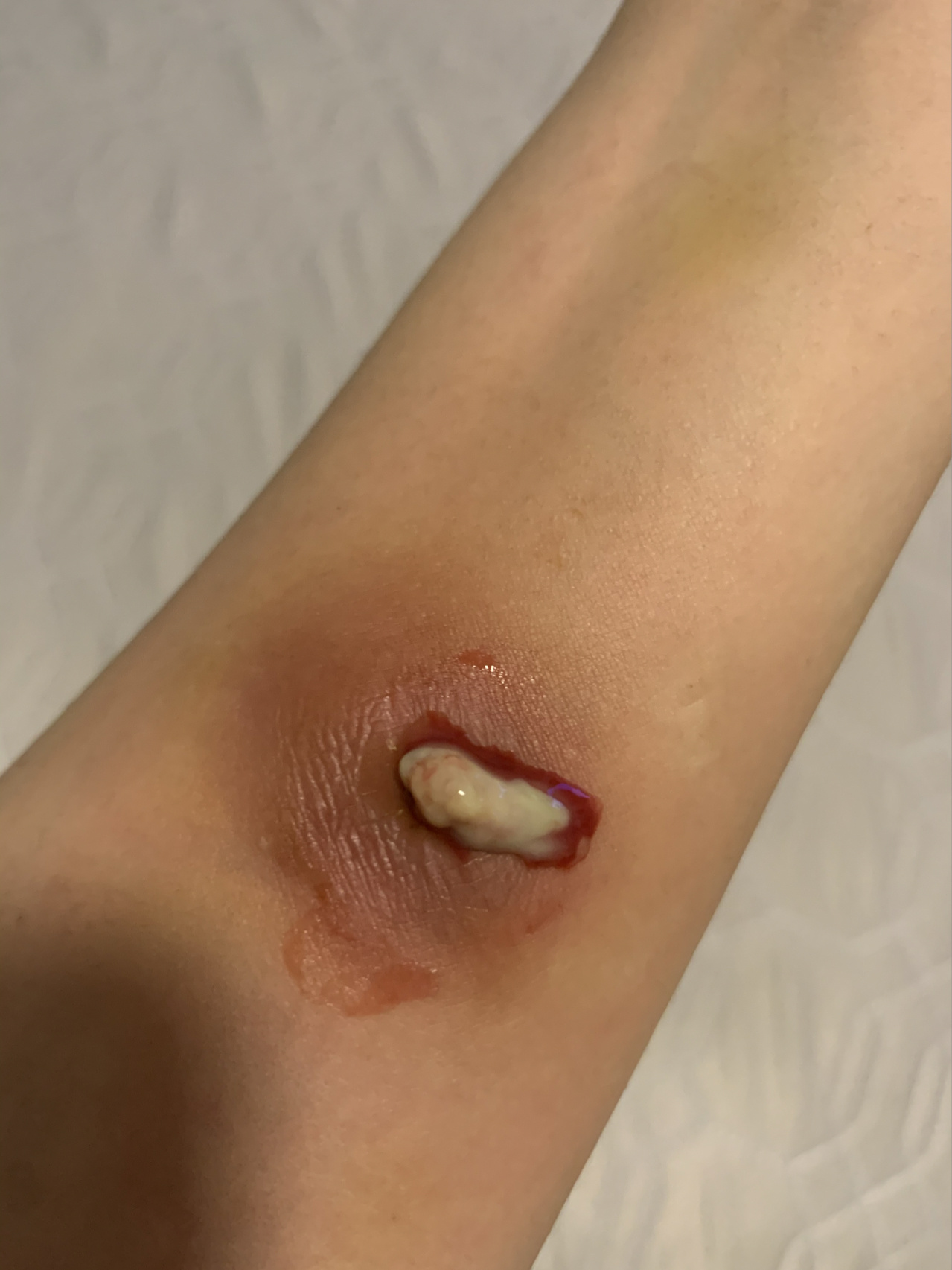 被虫咬了一口怎么办?