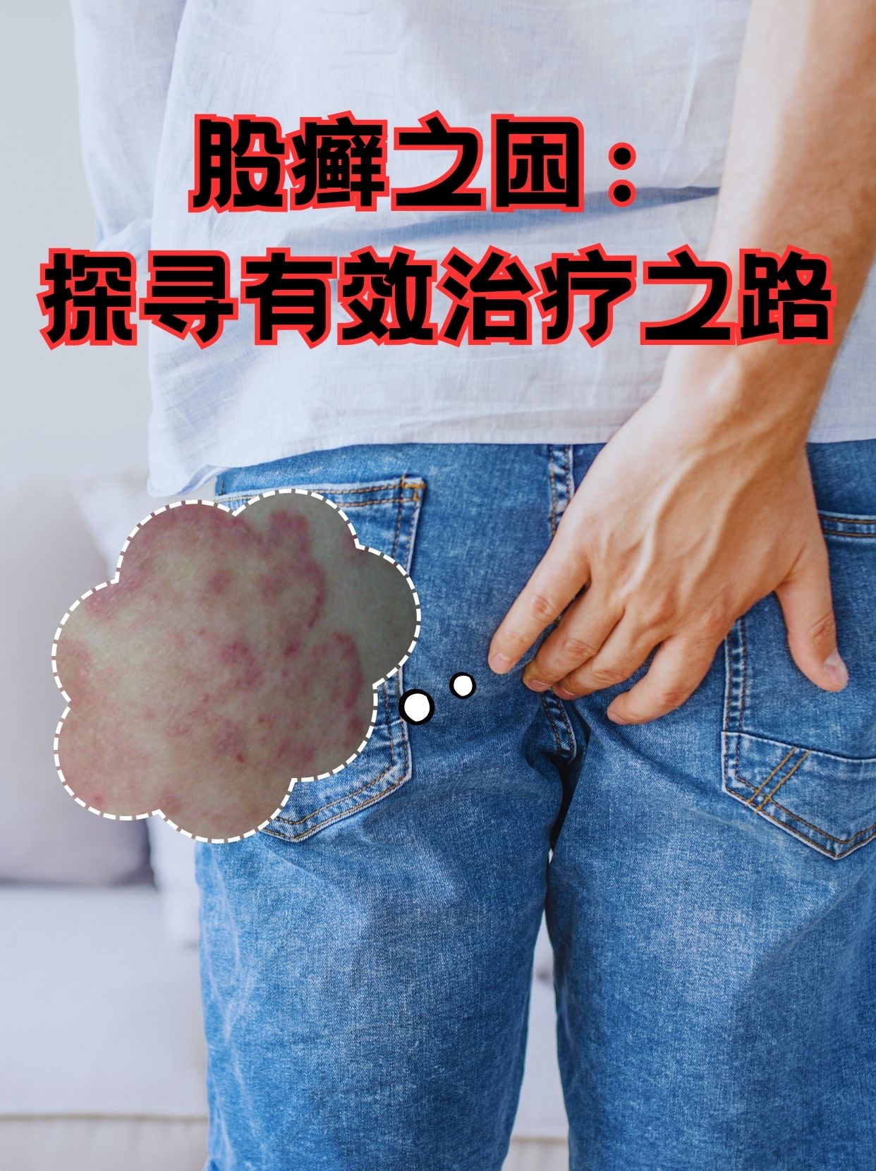 股癣是怎么引起的