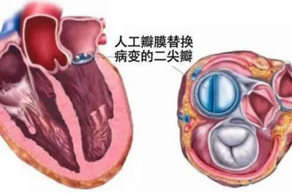 心脏瓣膜手术后寿命