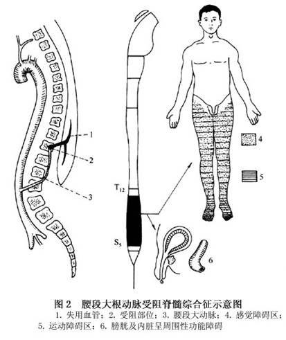 脊髓半切综合征