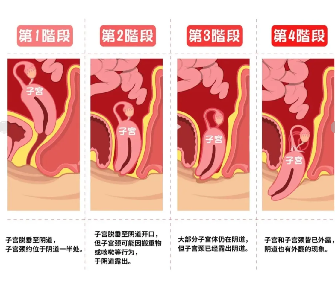 子宫脱落有什么症状