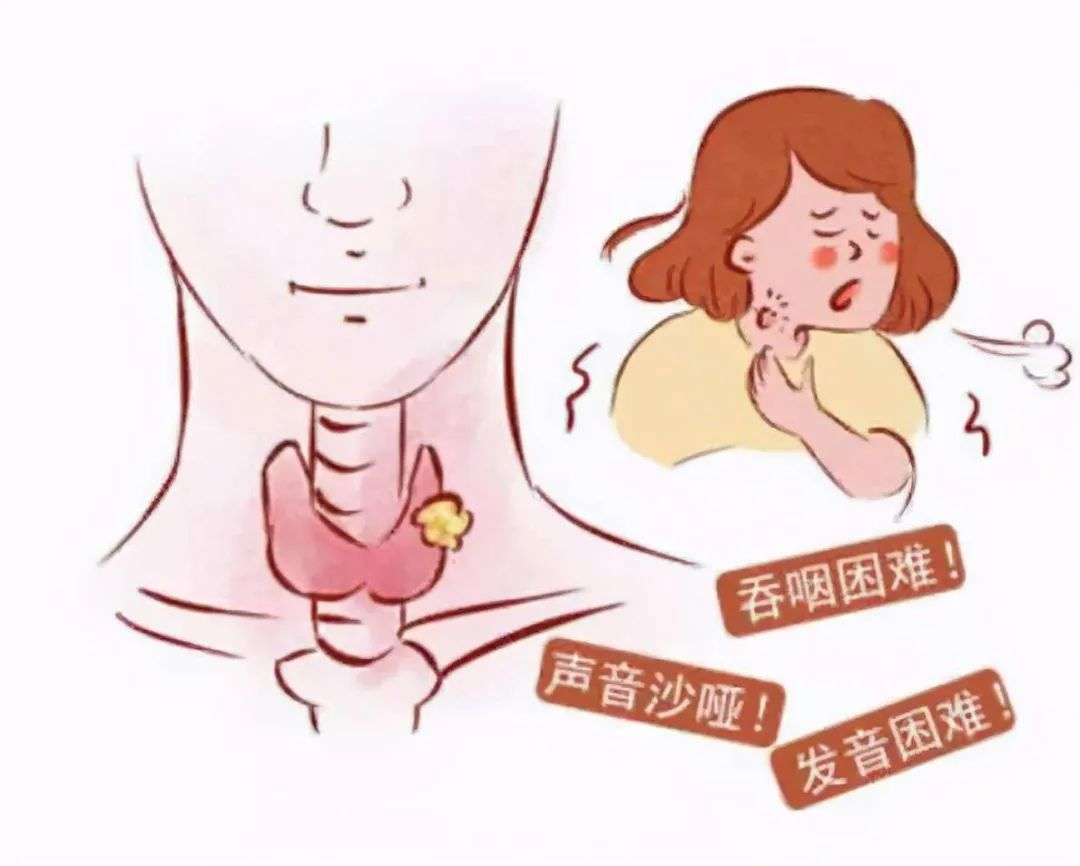什么是喉癌?