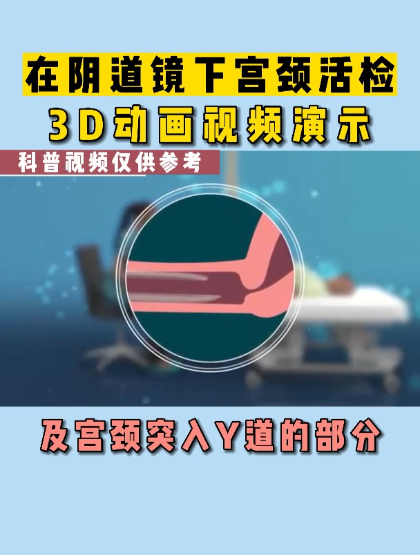 宫颈活检是什么意思