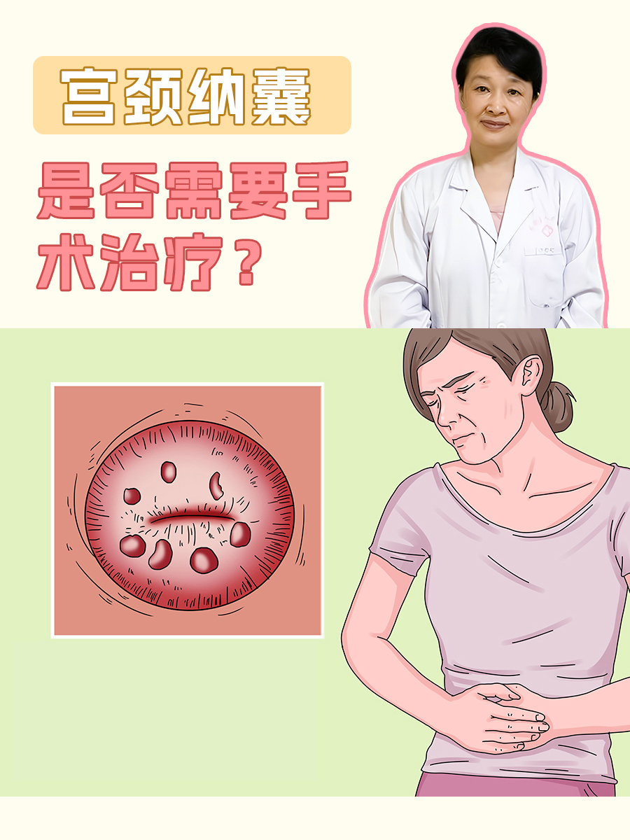 宫颈纳氏囊肿要治疗吗?