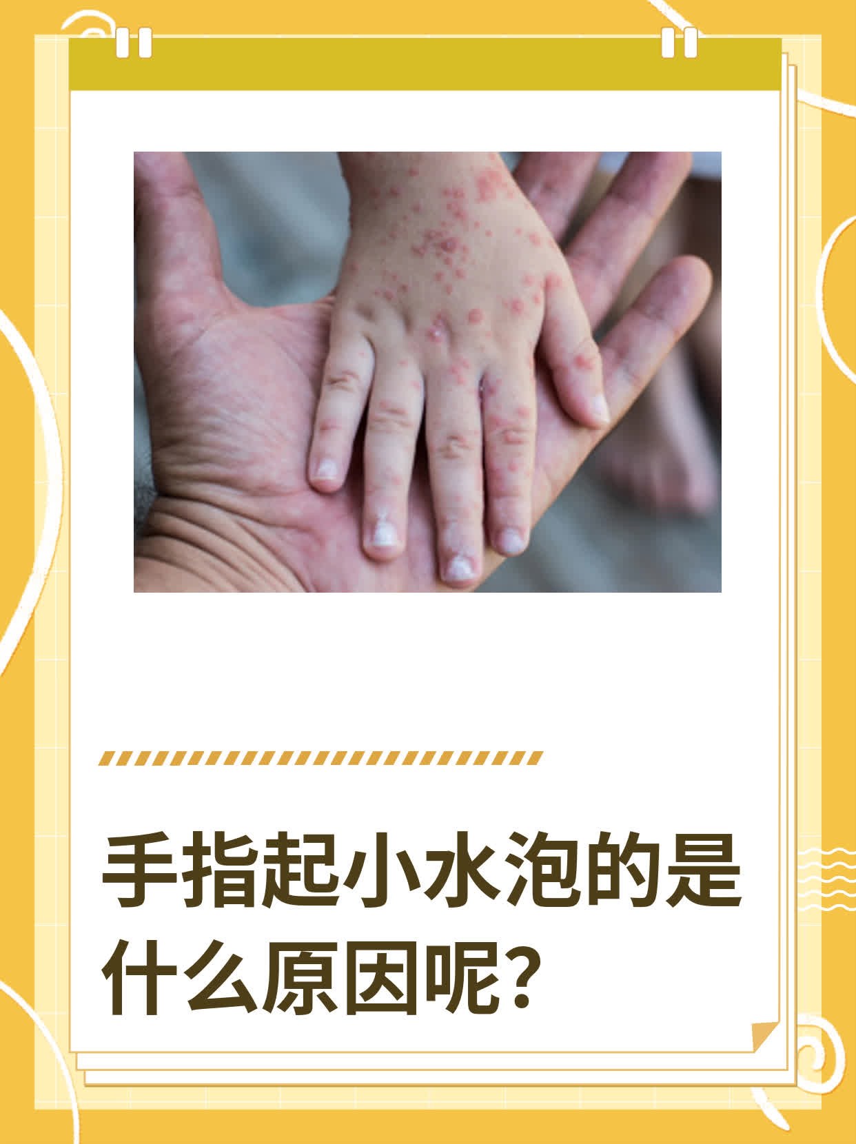 手上起小水泡怎么治疗