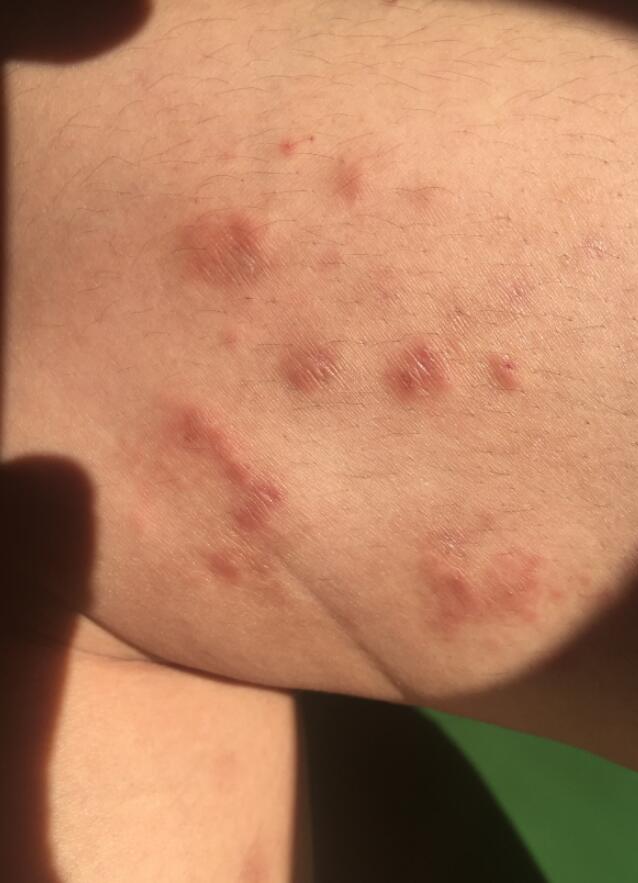 腿上长疙瘩