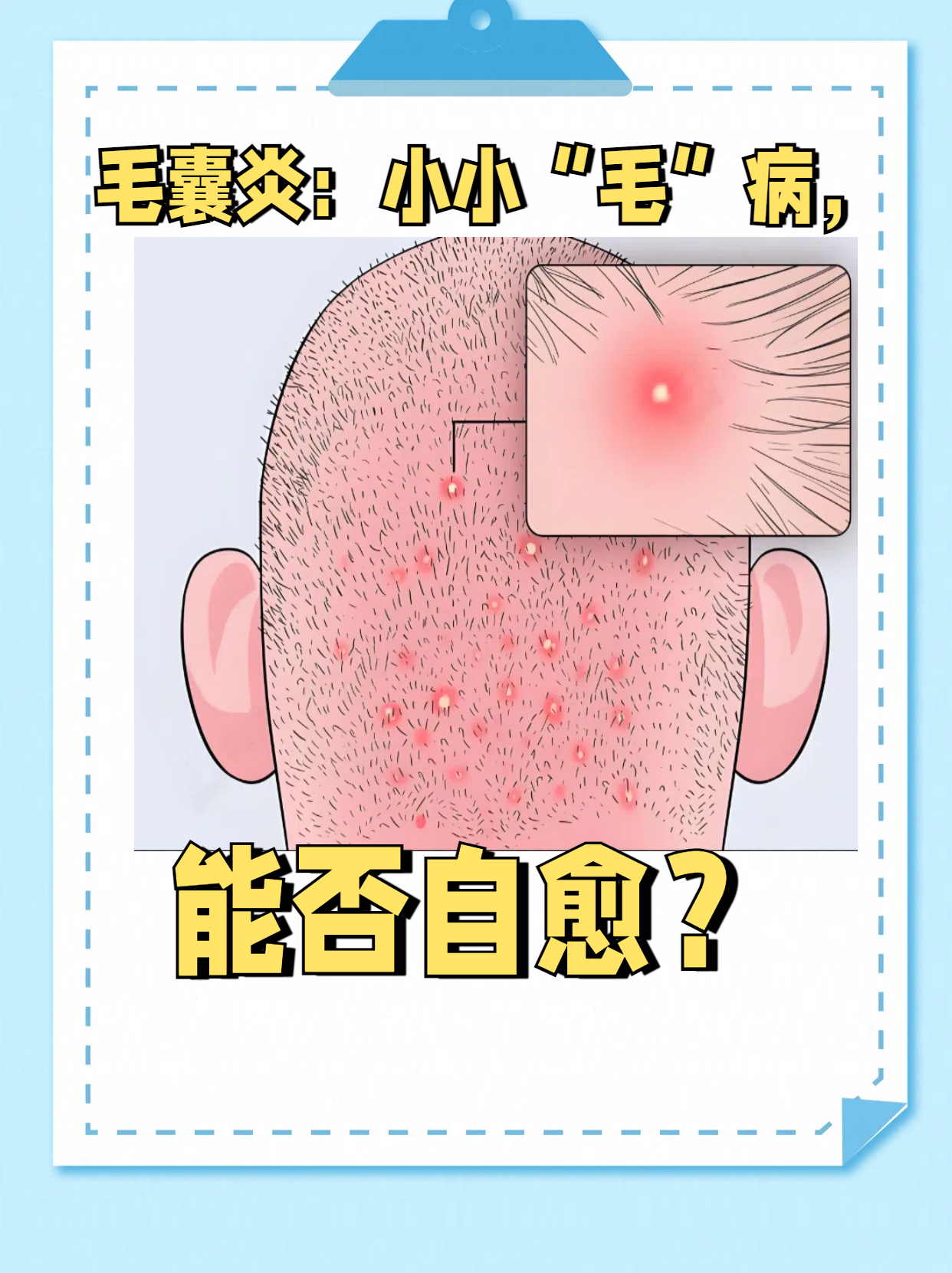 毛囊炎是怎么引起的?