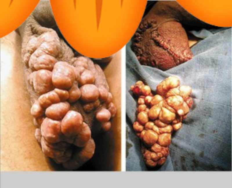 阴囊上长小疙瘩是怎么回事?