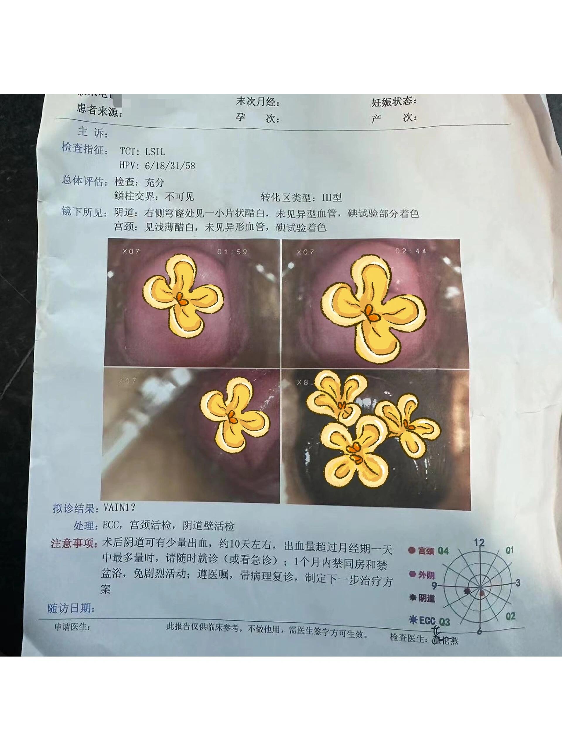 宫颈糜烂,白带带血,其他地方都很正常