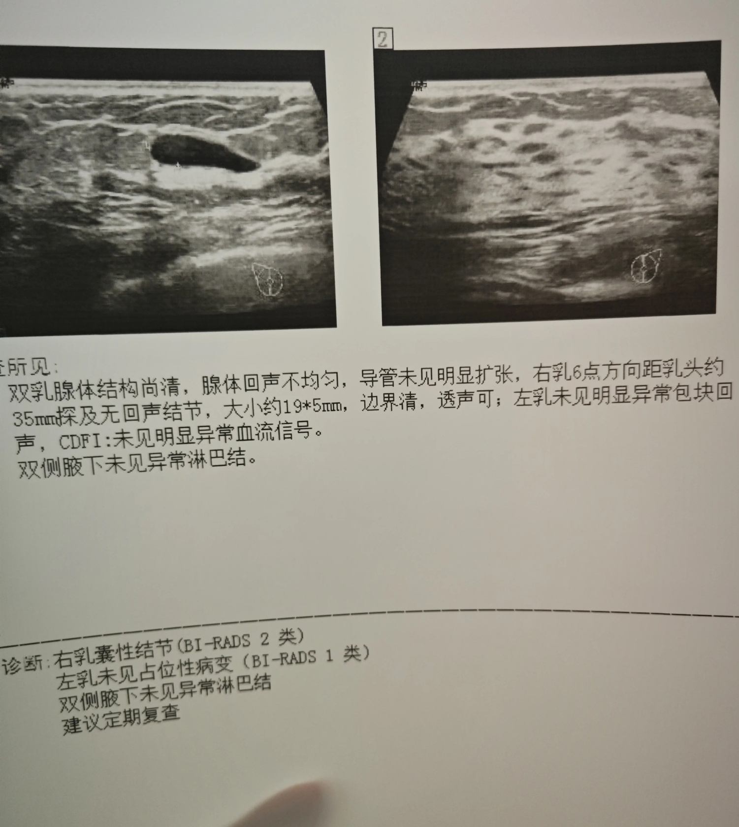 乳腺囊肿需要治疗吗?