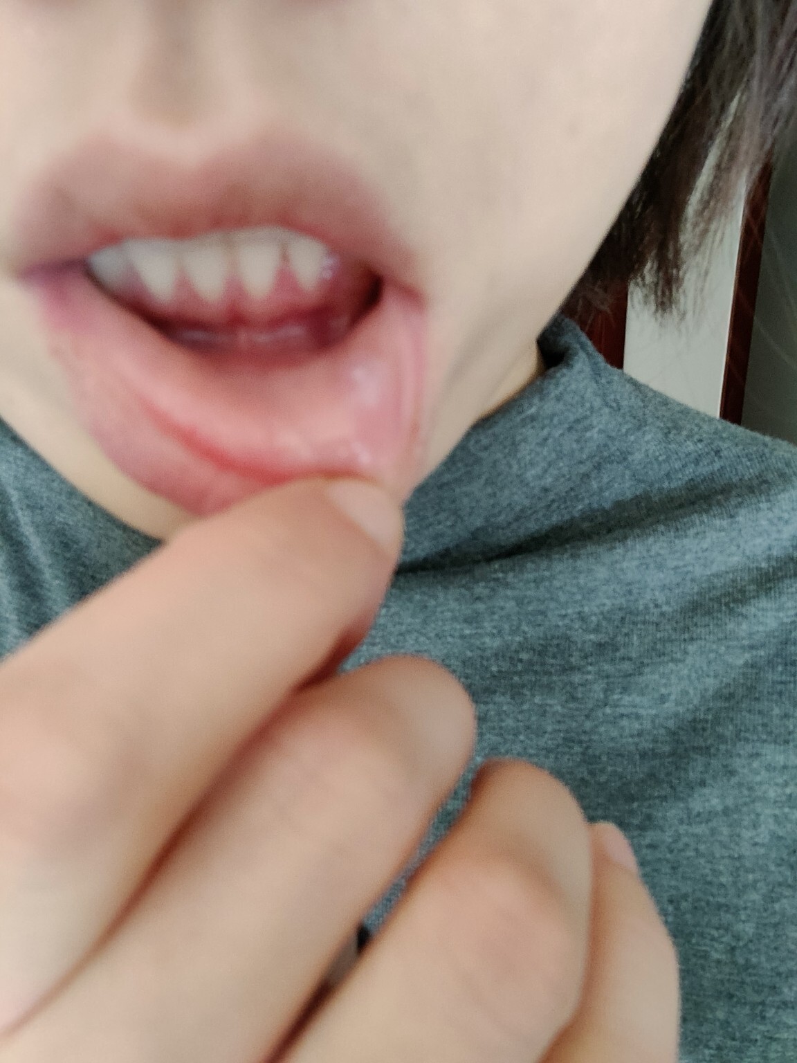 口腔粘液腺囊肿,两月了