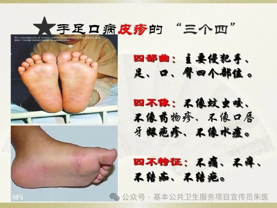 孩子得手足口病如何治疗