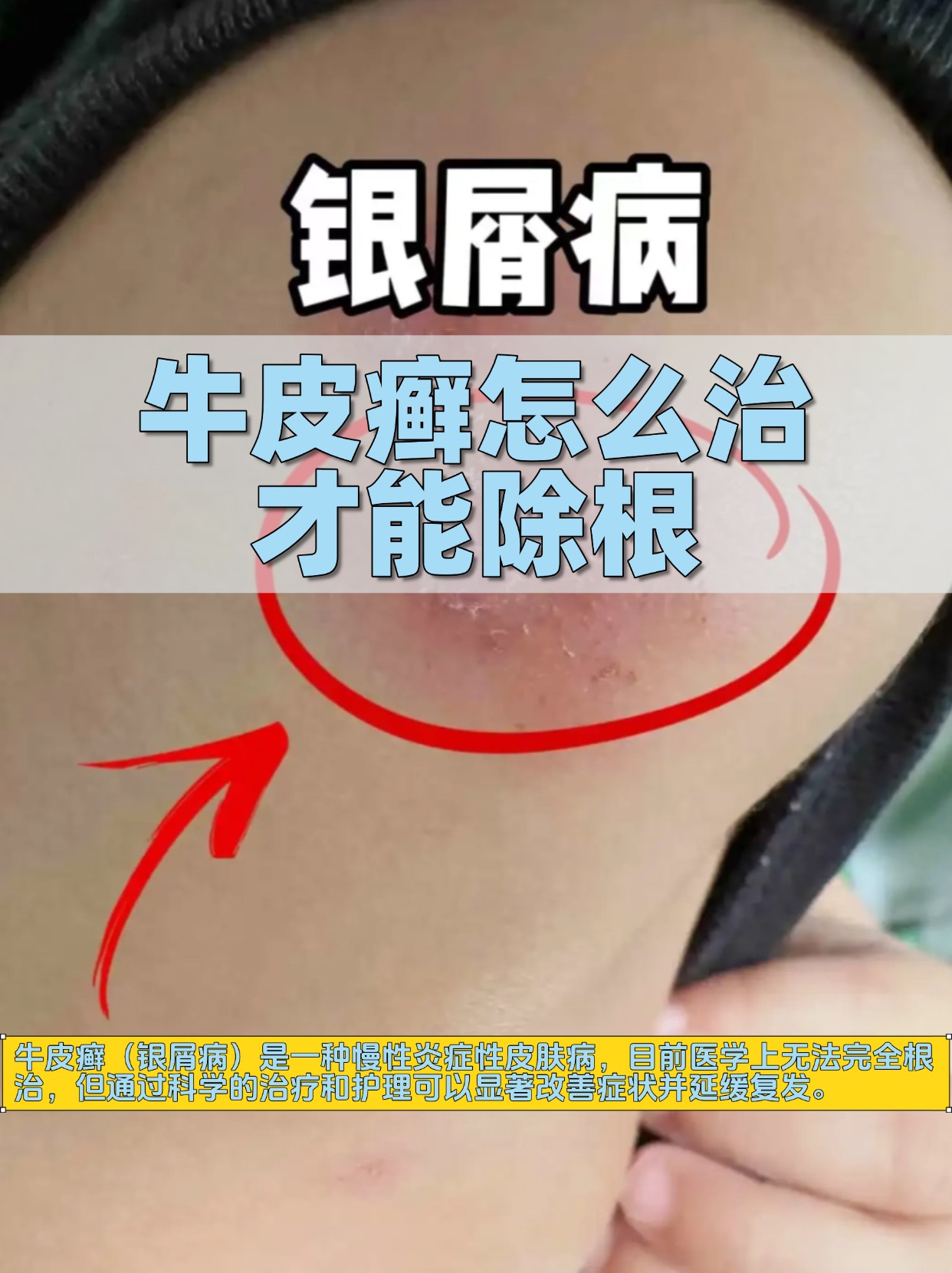 早期的牛皮癣怎么治疗?