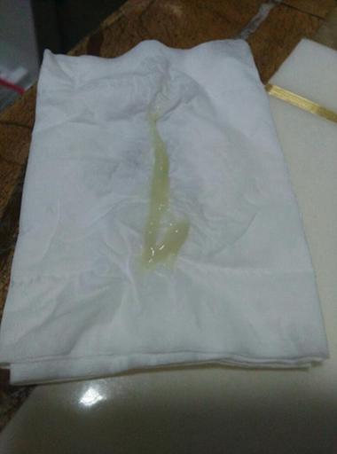 豆腐渣白带是怎么回事