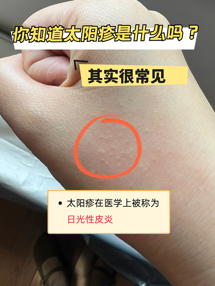 晒伤了怎么办?