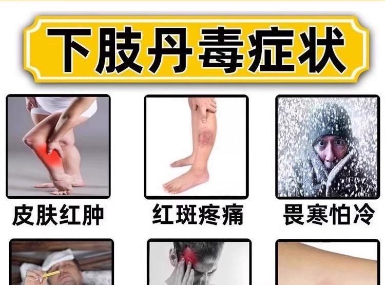 丹毒是什么病会传染吗