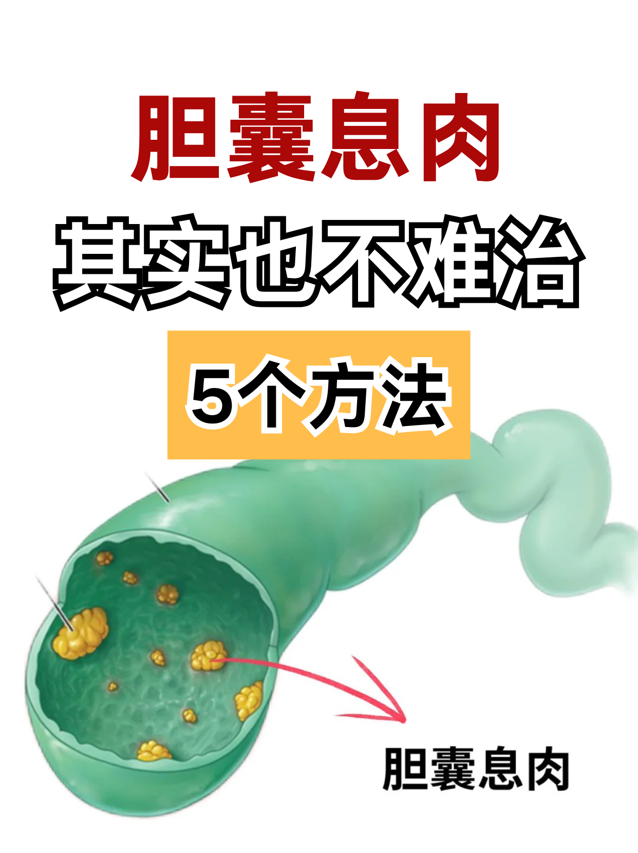 胆囊有息肉注意事项是什么?