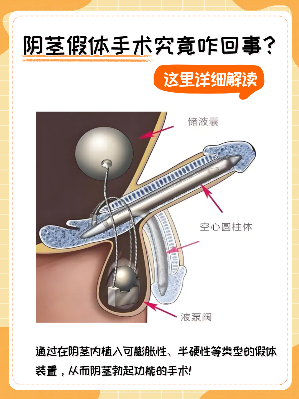 什么是阳痿