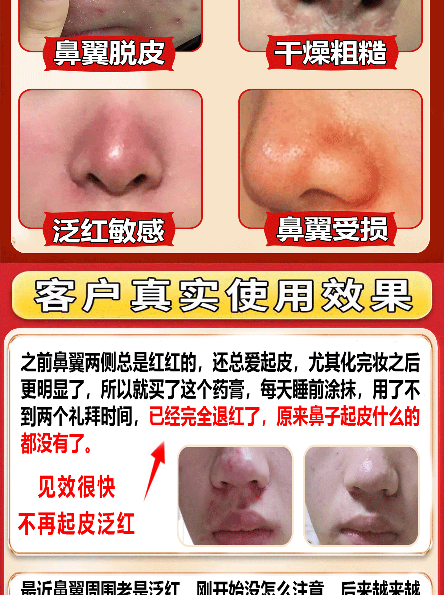 鼻翼两侧长粉刺是怎么回事