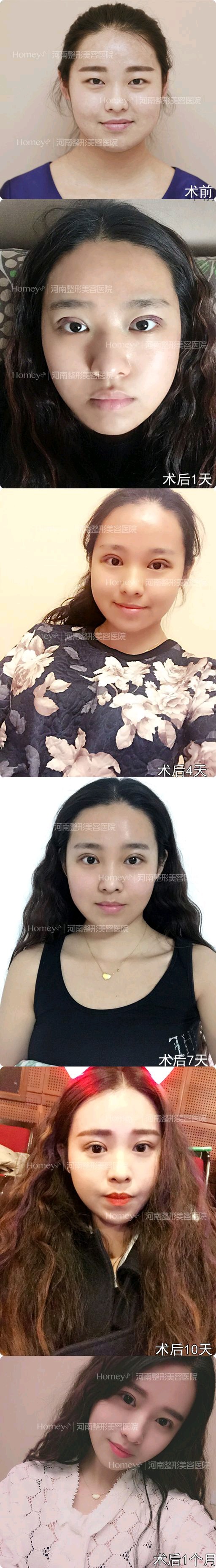 你好,请帮我看看我这个外翻吗?