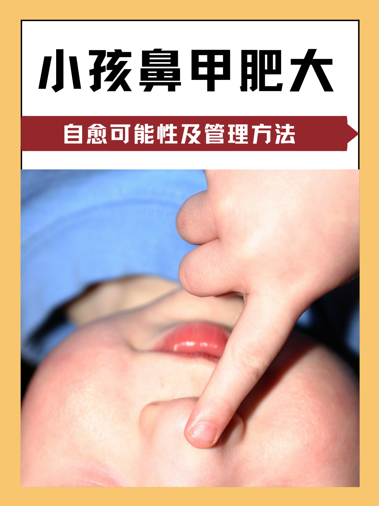 鼻甲肥大症状,怎么治疗效果好