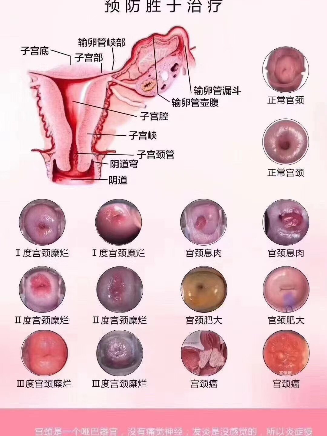 早期宫颈癌要怎么治疗?