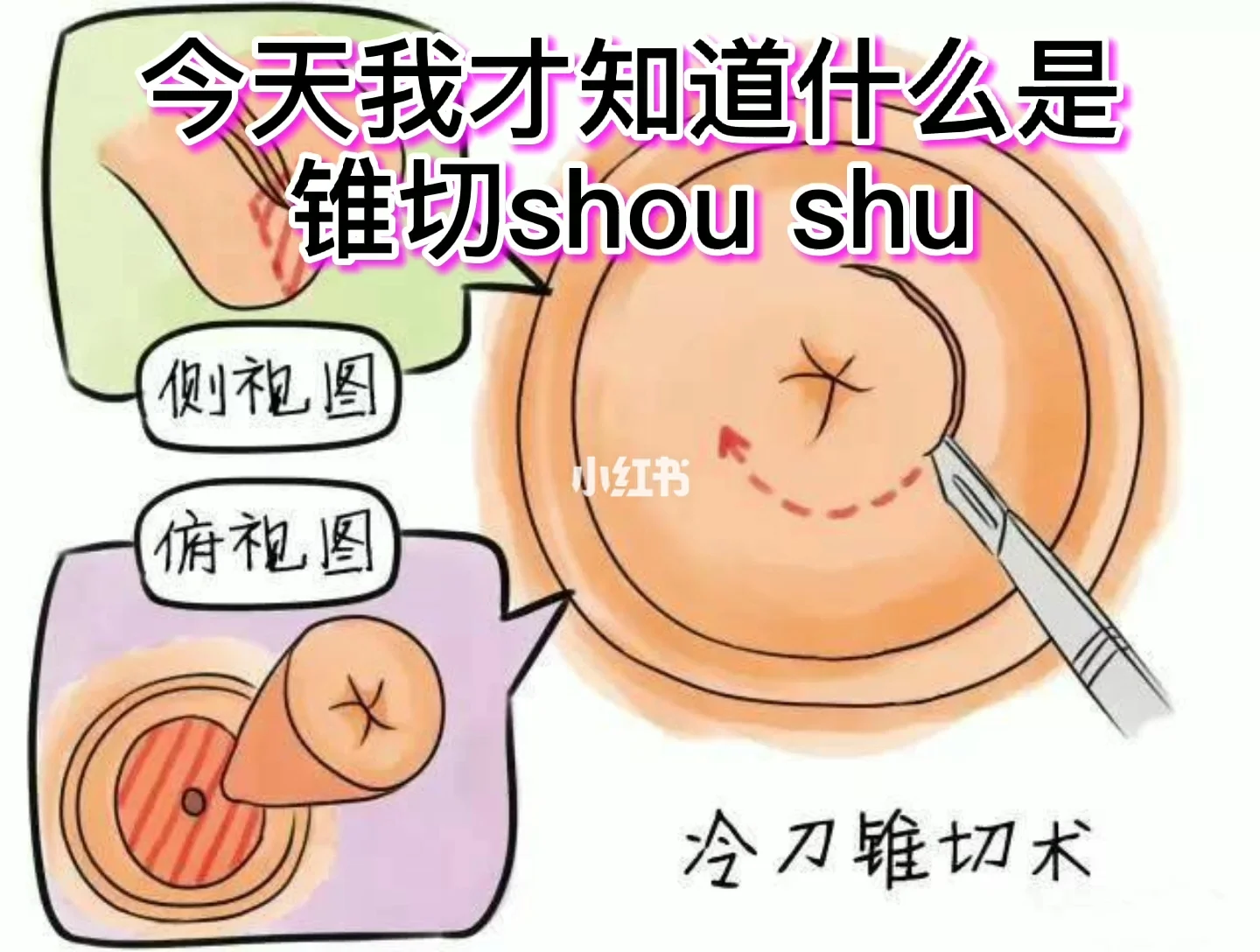 宫颈锥切术