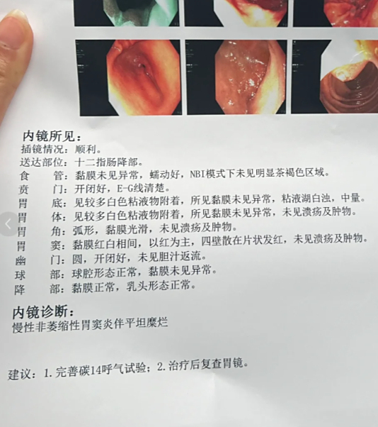 检查胃病有几种方法