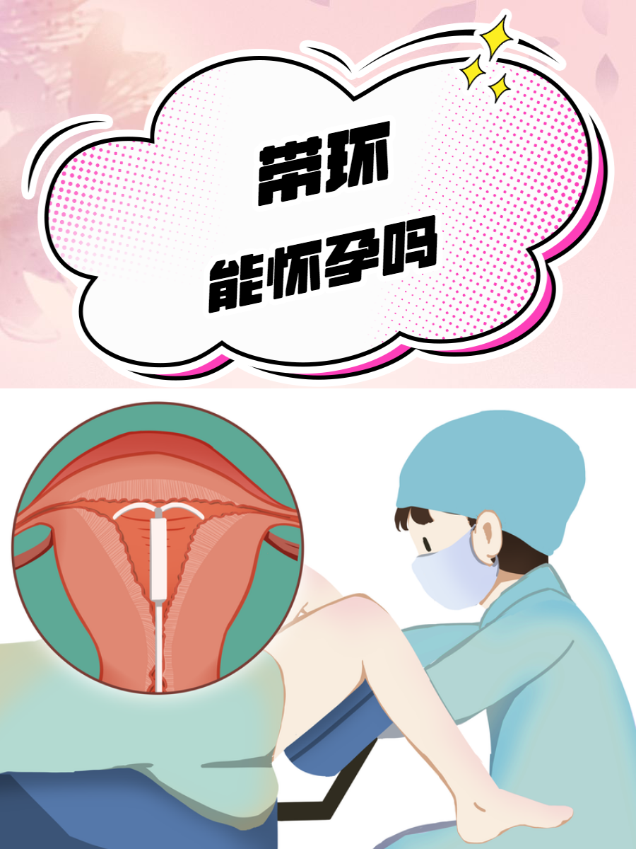 避孕环是什么