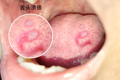 5天前长了两个不痛不痒的溃疡(图一)