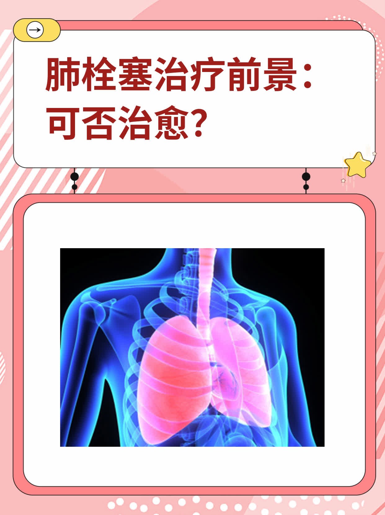 肺栓塞的病因